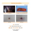 만성담낭염수술후기. 최초 복통이 시작되어 올해 4월까지 3회의 응급실 진료로 담낭에 돌이 있어 수술해야 한다는 진단을... 이미지