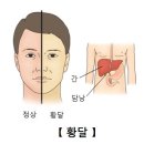 총담관 담석[CBD stone]소화기질환 이미지