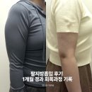 호리호리다이어트 | 팔지방흡입 후기 1개월 경과 회복과정 기록