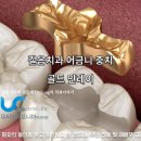 성신치과기공소 | (길음치과)어금니 충치치료 인레이레진 가격 치아인접면까지 후기모음
