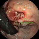 [하부위장관] Solitary rectal ulcer syndrome(SRUS) or Primary syphilitic chancre in the rectum 이미지