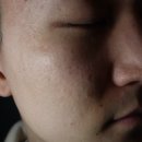 도안한의원 | [수원 여드름치료] 수원시청역 인계동 한의원 여드름 흉터치료 '내돈내산' 8회차 리얼후기⚡️