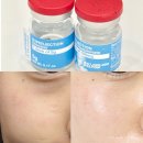 예소 - 남해군 동부대로1876번가길 6 | 청주 동남지구 피부관리, 예소뷰티 슈퍼젝션 받고 온 후기