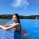 [대구 오타모반 치료 피부과 추천] 양측성 후천성 오타모반 레이저 치료 마지막10회차(2개월 간격...