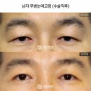 올바른디비 | 짝눈교정, 수술 후에도 비대칭이 남아서 고민이라면?