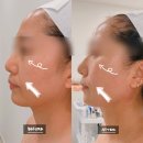 리뉴메디칼 대구지사 | 처진 볼살 탄력 고민? 온다리프팅 대신 아미뷰티 온써마 10만줄로 얼굴리프팅 종결