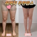(주)바이오라인 | 허벅지 무한람스 3달차 후기 : 일자다리 라인 만드는 후관리 조합 (중저주파, 코어스컬프)