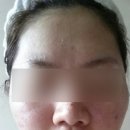 가야한의원 | 이대여드름피부과 한의원 추천하는 후기