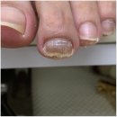 미엘네일닥터아이티엔범계지점 | 안양무좀발톱 미엘네일 닥터아이티엔 범계지점에서 해결