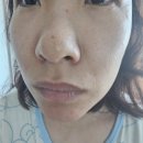 피부과 에서 사용하는 5세대 피부 재생 솔루션 라라올레&amp;라라닥터 제품 관리 후기