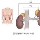 부신암 원인과 전조증상 놓치지 말아야 할 신호들 이미지