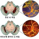 파킨슨병과 파킨슨병 증후군의 차이와 치료 방법 이미지