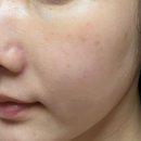 세포 | 압구정 포텐자 + 엑소좀 줄기세포 후기, 효과, 통증