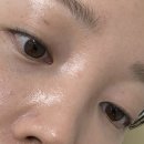 대신이.아이 | 부산 해운대 피부과 눈가주름 아이 써마지 대신 볼뉴머 받아 본 후기