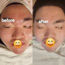 미인 | 군자역피부관리[에스테틱] 겨울철 여드름과 트러블 자연 미인 에스테틱 후기