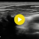 Medullary thyroid ca(갑상선 수질암)와 전이성 림프절(invasion LNs) 이미지