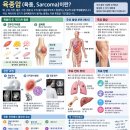 육종암, 어떤 병인가…의학적으로는 ‘육종(sarcoma)’ 이미지