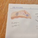 유방 혹)두 병원 소견 다른 후기, 맘모톰 권유/비권유, 맘모톰 후기