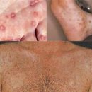 성병 매독 초기증상 전염 원인 남자 여자 증상 매독 검사 치료 피부 발진 이미지