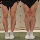 서초대로34길 31 | 윤아 오다리 교정 원리(실제 후기)
