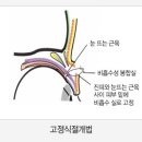 [에이블성형외과] 쌍꺼풀수술 절개법 종류와 장점 이미지