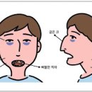 아데노이드 비대 원인 증상 아데노이드 수술 실비 아데노이드형 얼굴 이미지