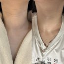 볼륨15구미점 | 구미 산동 리프팅 관리 치리에스테틱 목주름 하이푸 전후비교사진