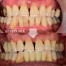 파주본치과의원 | 파주문산치과 치주염으로 흔들리는 치아 복합 치료 사례