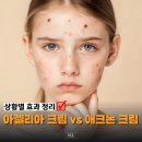아젤리아 | [공지] 20대 실제 사용 후기 “아젤리아 크림 vs 애크논 크림” 여드름에 그냥 쓰면 안 되겠는데요