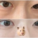 대전 눈밑지방재배치 지방이식 수술 내돈내 2주 차 후기(부기, 멍, 화장 등)