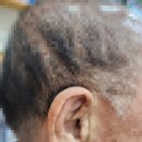 여해한의원 | 가곡동에 거주하시는 아버님, 1년8개월 전에 왼쪽에 오픈형 보청기를 사용하고 계셨는데, 반대쪽 착용 후기