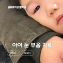 장상3 | 아이 눈 부음 장상 및 알레르기 결막염 원인 및 안약 처방 관리법