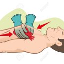 심장 마사지[cardiac massage] 이미지