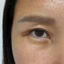 (주)디엘 | 디엘성형외과 눈재수술(절개눈매교정,뒤밑트임)+코재수술(자가늑) 후기