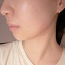 김지은피부과의원 | 압구정 피부과 인모드 무턱필러 후기 비수술 윤곽 얼굴 만들기