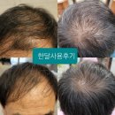 두피 / 탈모 / 출산후탈모 두피트러블 / 닥터메종 모리나모 플러스 샴푸로 고민 해결해드릴께요