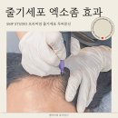 임의원 | 헤어라인 고민 해결, 줄기세포 엑소좀 효과와 두피문신 리얼 리뷰