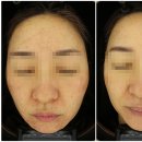 방학동피부과 스킨부스터 고민중이라면? &lt;효과, 통증, 권장대상&gt;