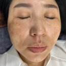 제시뷰티포항1호점 메이크윤 | 포항피부관리 메이크윤에서 편평사마귀 제거하기