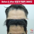 맨투남성의원 | 30대 남성 M+C자 탈모 비절개 투블럭 3800모 두피문신 부위 모발이식 12개월 후기