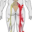 방사통 뜻 증상 하지 다리 어깨 : 목디스크 허리디스크 원인 살펴보자 이미지