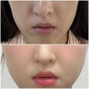 성북2 | 성북구피부과 팔자주름 레디어스 2회차 후기 비용 통증 결절