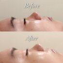 나인 메디칼 | 청주피부관리 스파나인 강서점에서 받은 비앤서 LDM 관리 후기