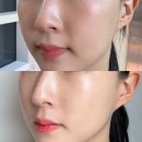 논현역 피부과 딜라이트하게 리쥬란 더마샤인 후기내돈내산