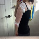 팔치지 | 예신 다이어트 팔뚝 람스 상담, 시술 당일 솔직 후기