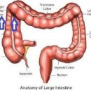 대장암 Colorectal cancer, 대장선암(colorectal carcinoma), 결장암(colon cancer), 직장암(rectal cancer) 이미지