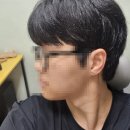 턱이아름다운치과의원 | 남자 턱 보톡스, 피부과 vs 치과 후기