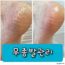 눈시울에난털 | 선물! 농사일로 거칠어진 발톱과 갈라진 뒤꿈치, 아기 발로 되찾아드린 감동 후기 (푸스케어 용인역북점)