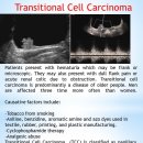 Urinary Bladder_Transitional cell carcinoma 이미지