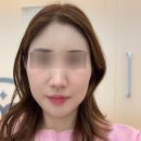 리부팅의원 관자필러 후기